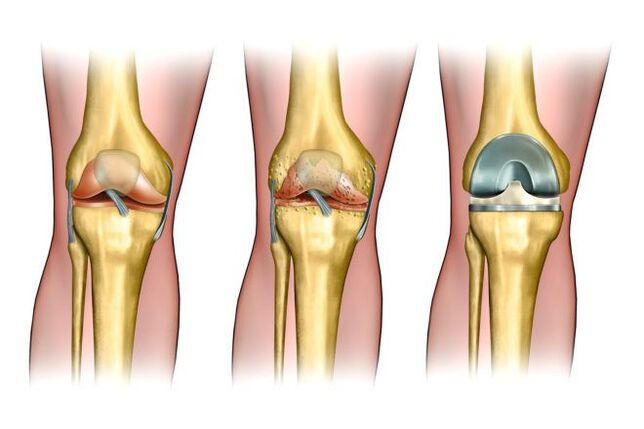 degré d'arthrose