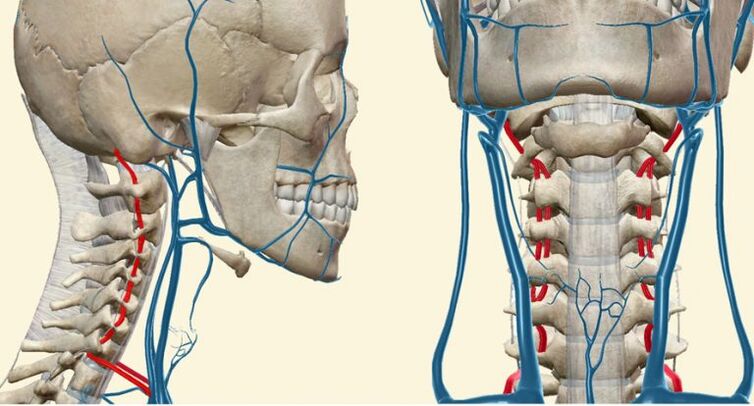 Syndrome vasculaire dans l'ostéochondrose